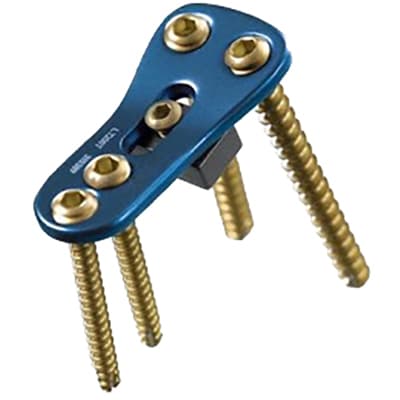 Proximal tibia osteotomy plate