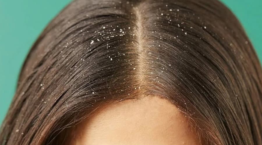 What is dandruff?